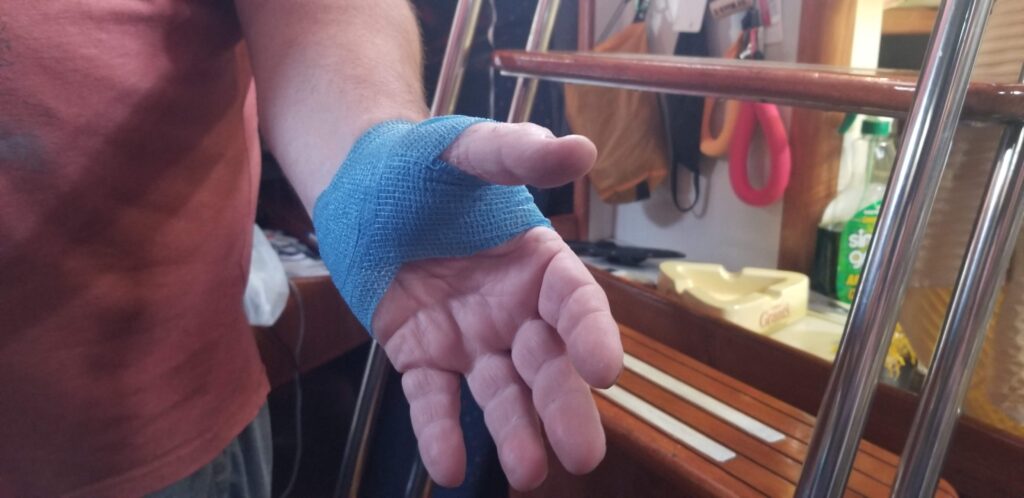 photo of a man's left hand wrapped in bright blue bandages. 